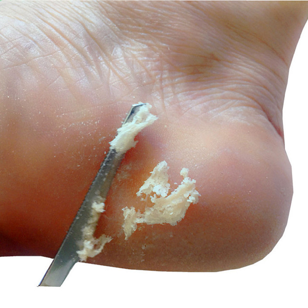 dropship 1 Pcs Stainless Steel Pedicure Scrapers Callus Knife, Pedicure Scrubber Tools, Foot File Dead Skin Remover Tools